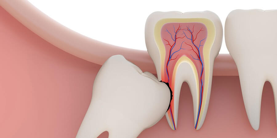 Удаление зуба мудрости: что нужно знать перед процедурой